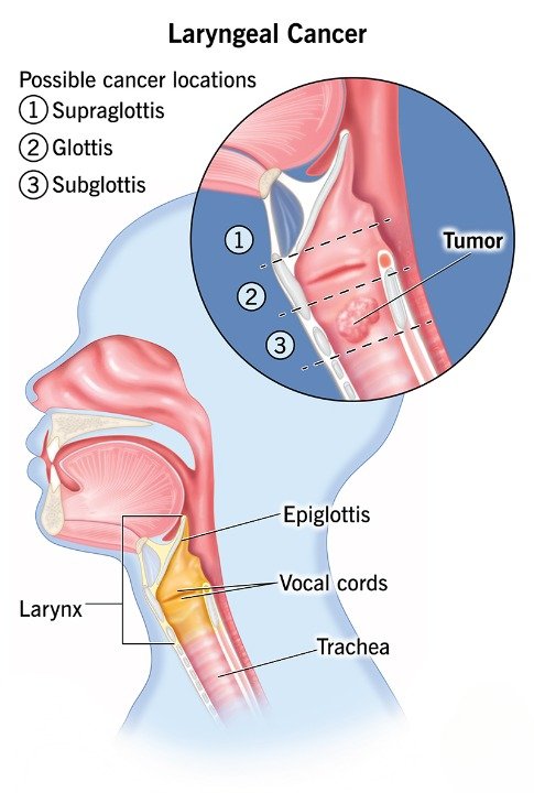LARYNGEAL CANCER