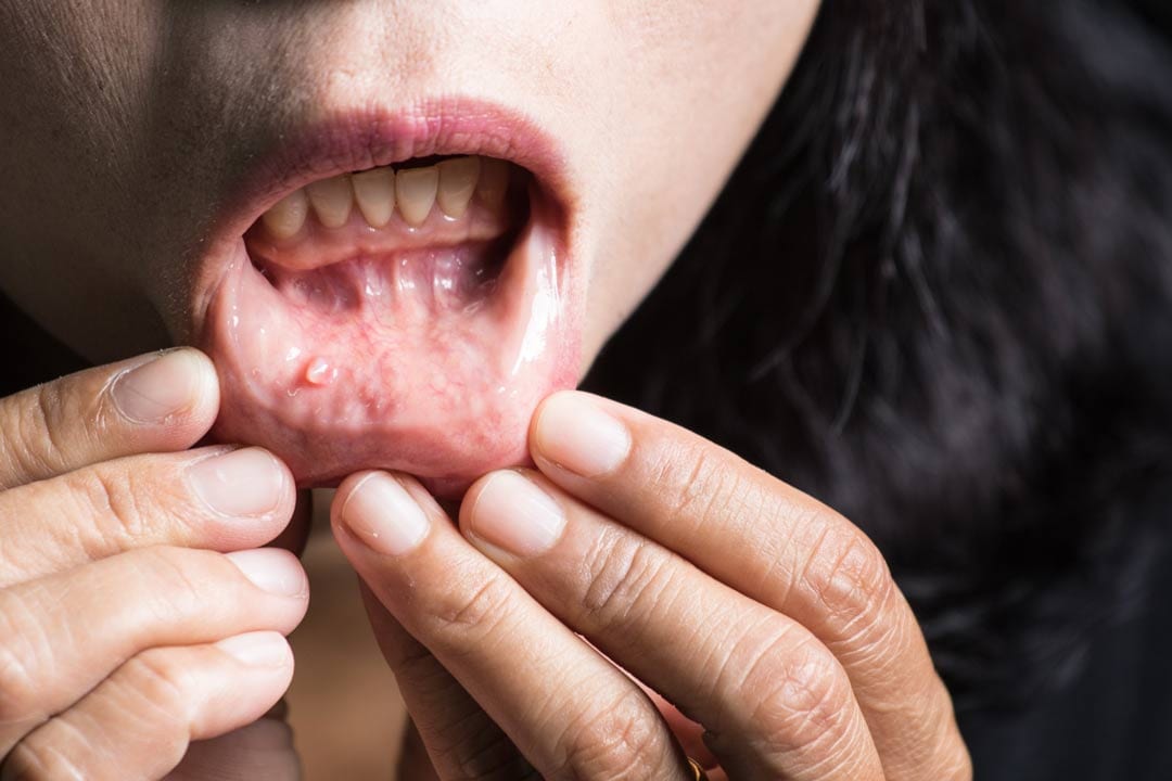 Oral Cancer