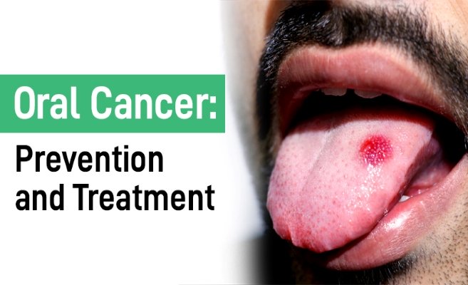 Oral cancer treatment