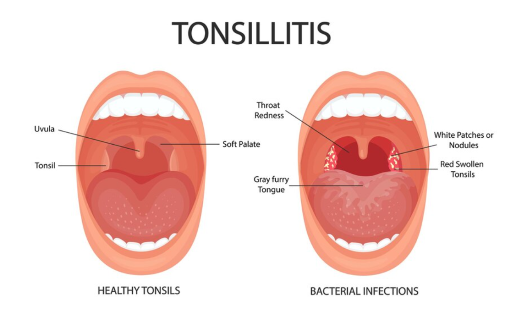 Tonsillitis Surgery in Bangalore