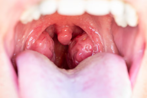 tonsillitis surgery